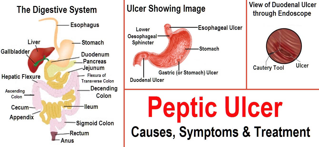 Peptic Ulcer Histology